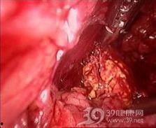 膀胱癌保守治疗吃小瓜,小瓜助力健康生活